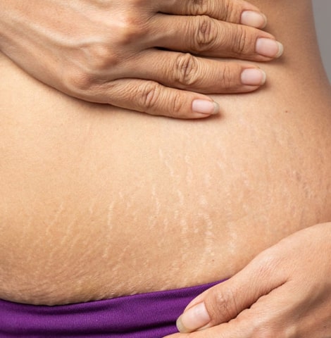 Image14212022 03 03 17 50 33stretch marks featured
