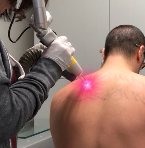 Image15002022 03 03 17 41 58tatoo removal featured