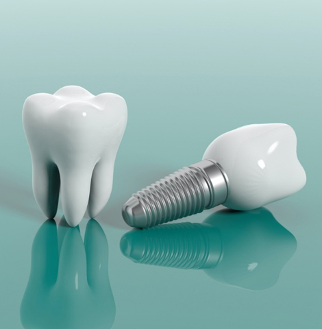 Image18932022 03 03 10 41 49implants